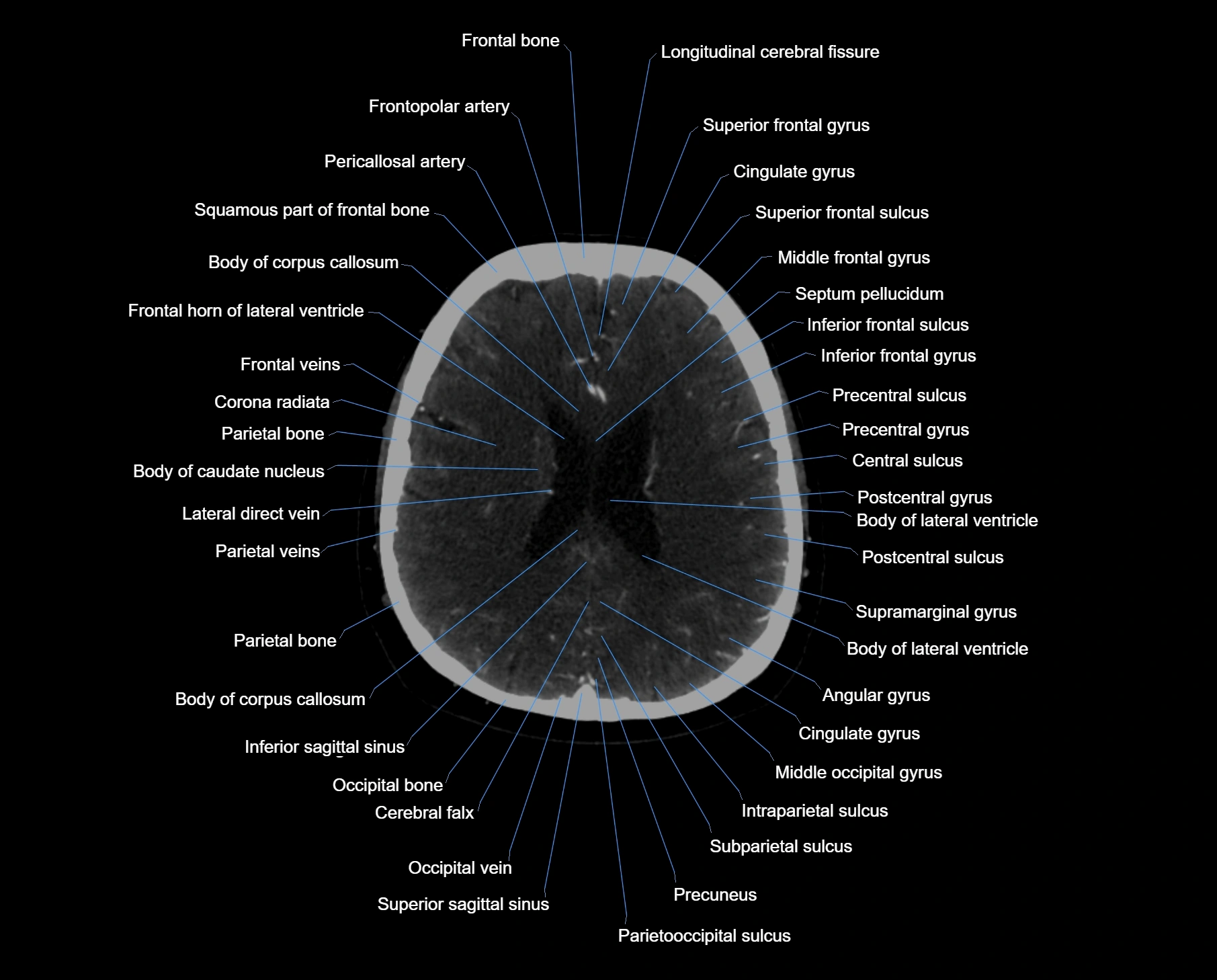 CT scan brain axial labelled cross sectional anatomy image-img-000046.webp